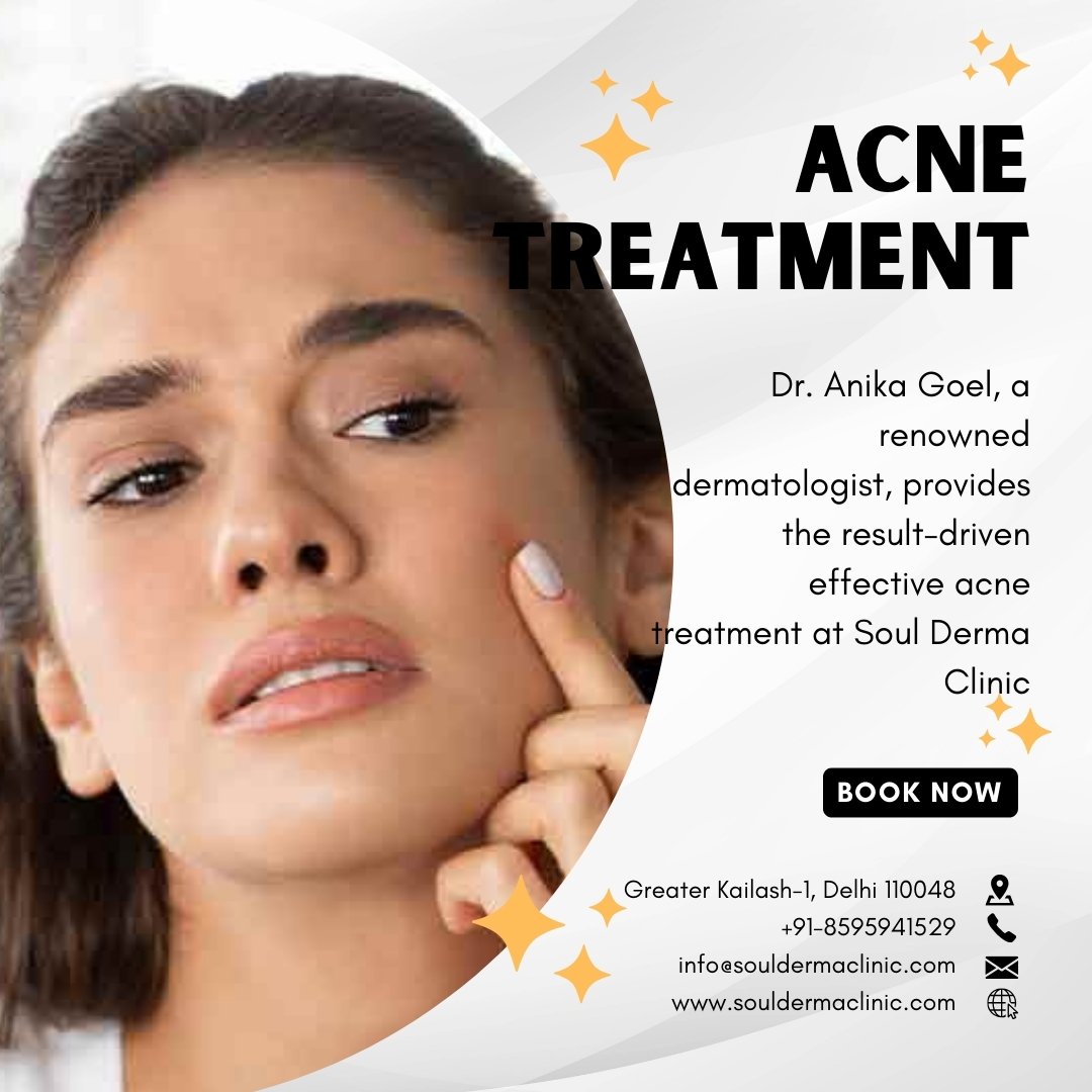 Get Acne Treatment In Greater Kailash At Soul Derma